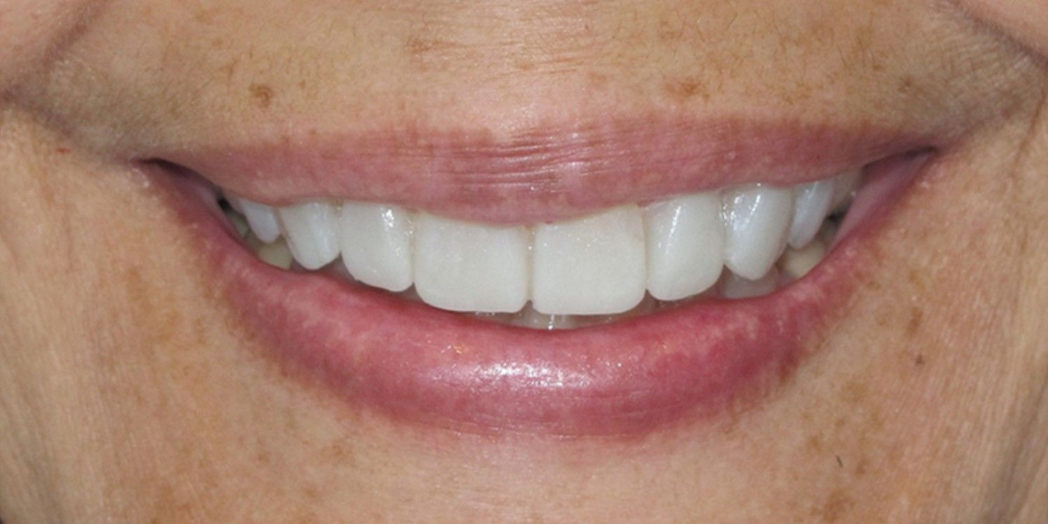 After TMJ Treatment Perfect Bite Alignment in Nallakunta Hyderabad - Smile Transformation