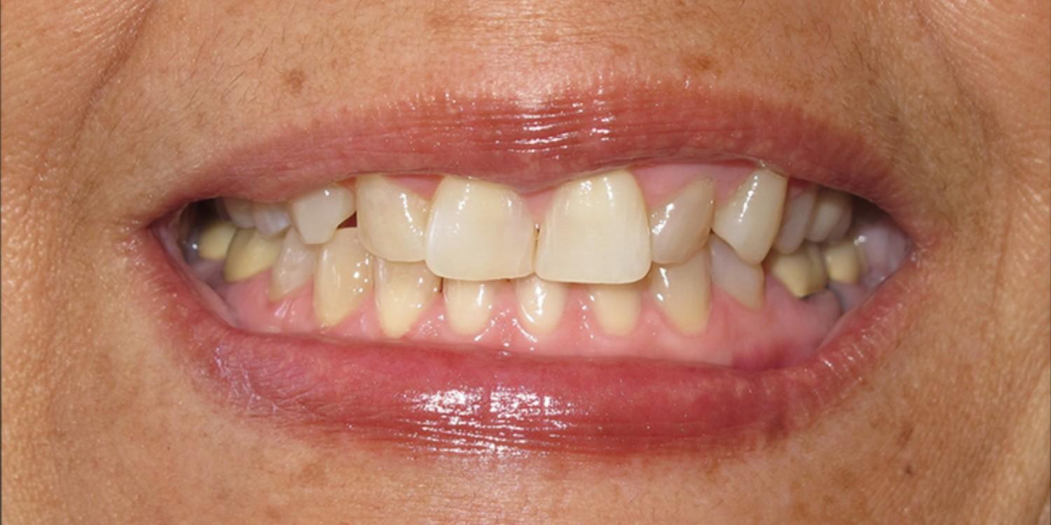 Before TMJ Treatment Bite Misalignment in Nallakunta Hyderabad - Close-Up Teeth View