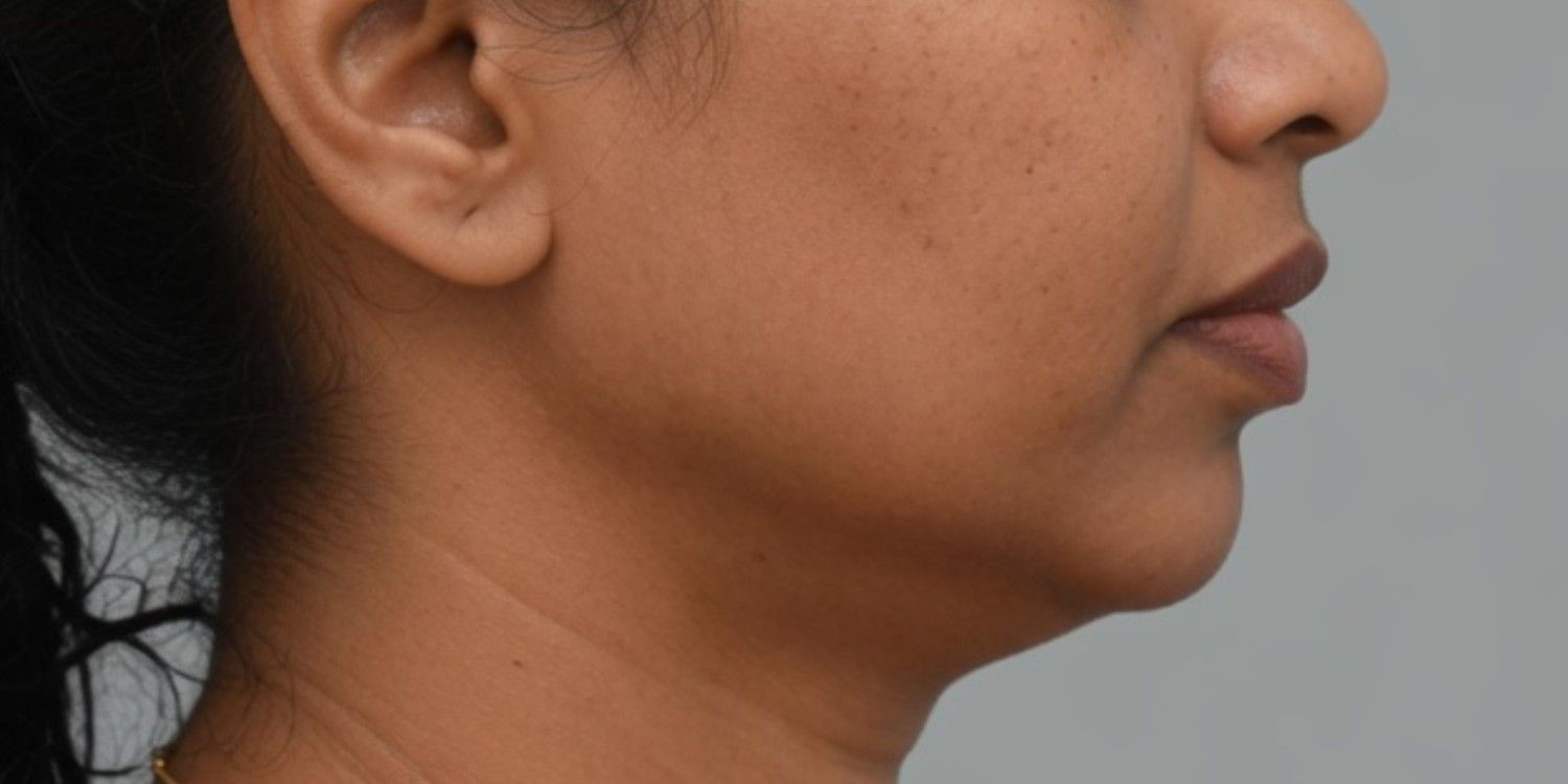 Before TMJ Treatment Jaw Misalignment in Nallakunta Hyderabad – Female Side Profile